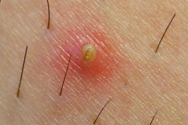 An ingrown hair.