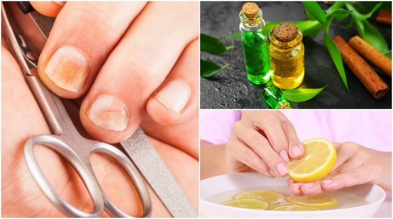 5 Tricks to Eliminate Nail Fungus & Strengthen Nails