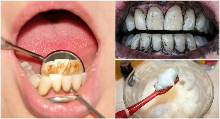 3 DIY Treatments to Remove Tartar from Your Teeth