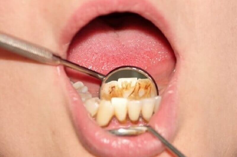 dental tartar