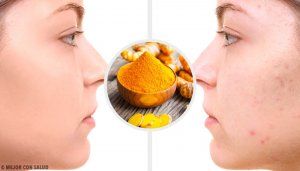 5 Turmeric Masks for Acne Scars