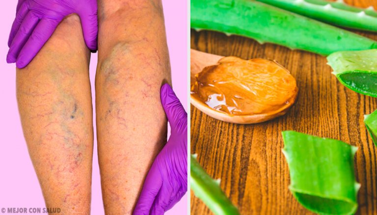 Cure Varicose Veins with this Aloe Vera Remedy