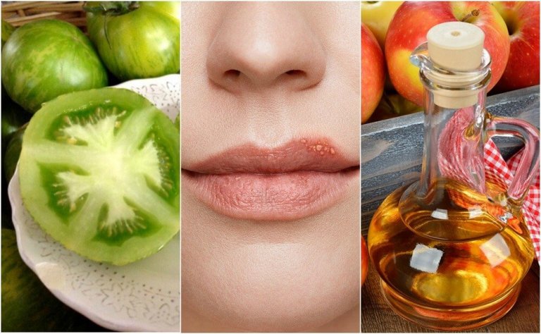 Fight Cold Sores with 5 Natural Treatments