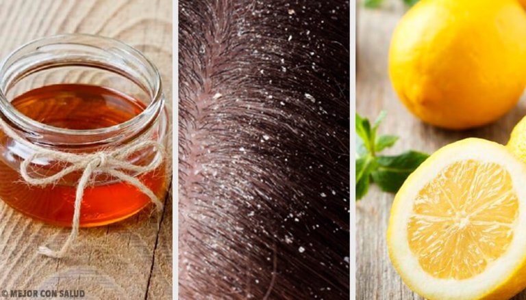 10 Effective Natural Remedies for Dandruff