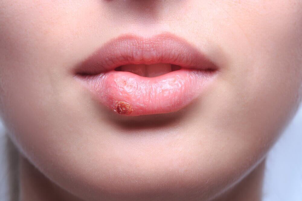 cold sores