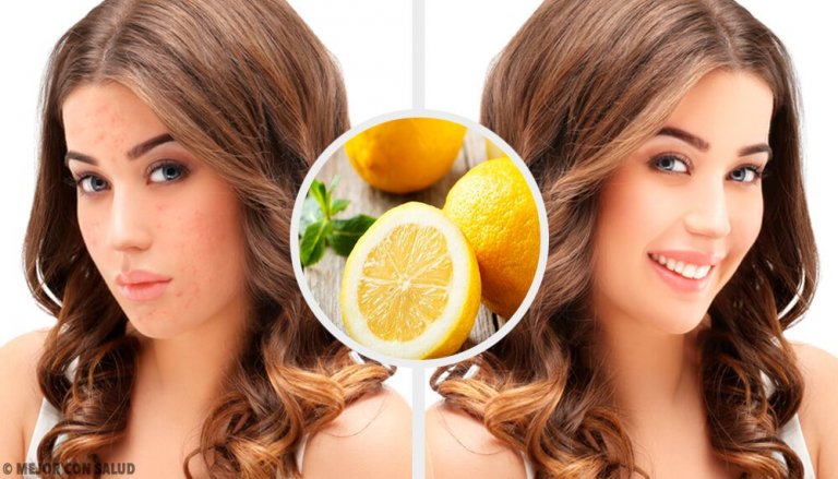 4 Natural Home Remedies to Eliminate Acne Scars