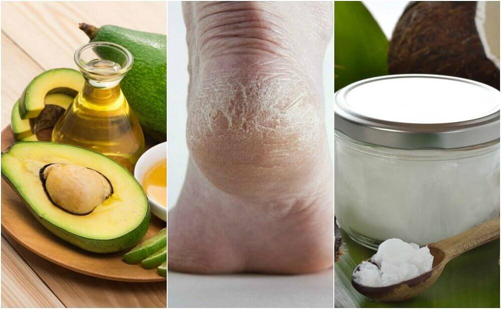 5 Homemade Creams to Moisturize Cracked Heels