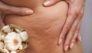 5 Ways to Fight Cellulitis
