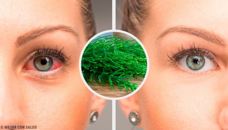 7 Recommendations to Fight Pink Eye Naturally