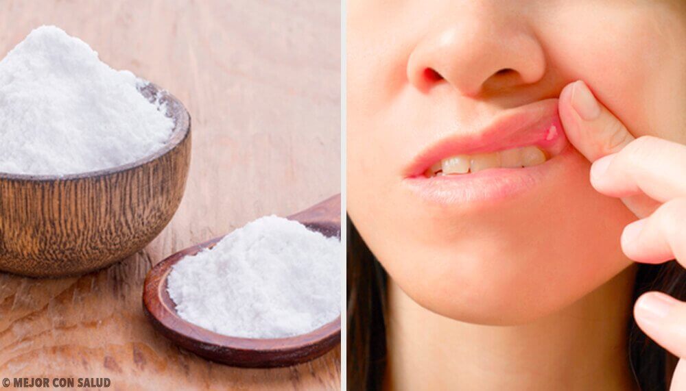 8 Remedies to Heal Mouth Ulcers 8 Remedies to Heal Mouth Ulcers