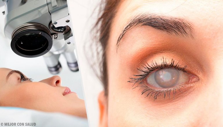 8 Symptoms of Cataracts and How to Treat Them Naturally