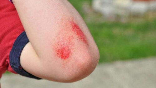 A person with a scraped shoulder.