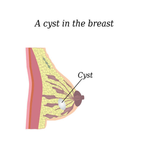 An illustration of a breast cyst.