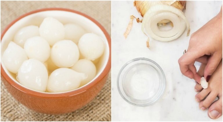 Calluses on Your Feet? Get Rid of Them with This 100% Natural Solution