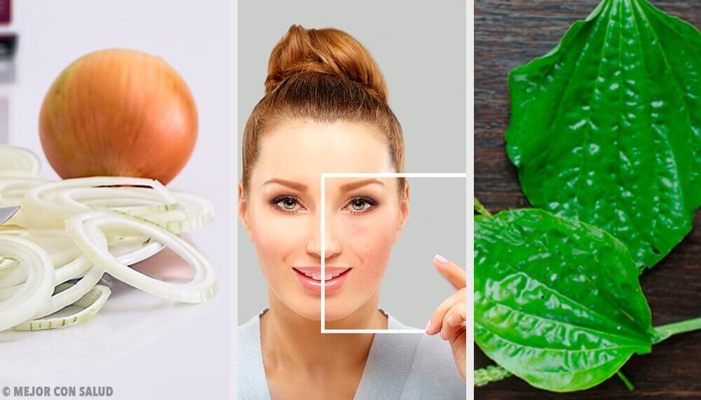 Eliminating Blemishes with Natural Ingredients