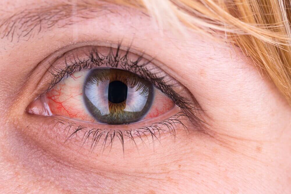 Fight Pink Eye