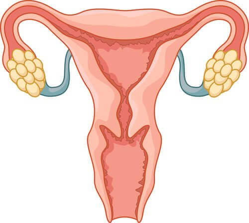 PCOS: a cause of infertility.