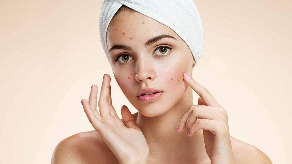 A woman with acne.
