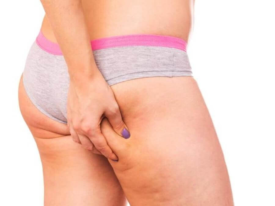 cellulite in woman's thigh