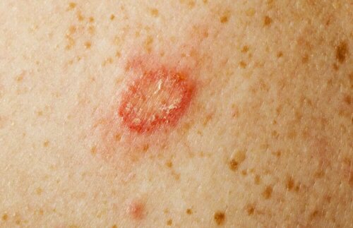 close up skin infection red
