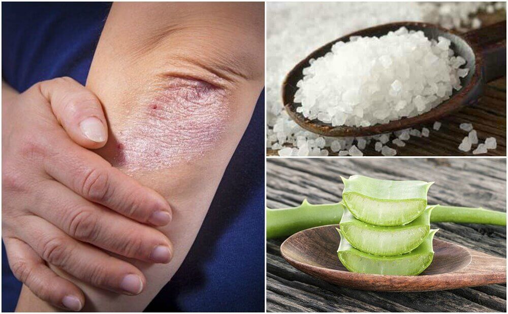 Fight Fungus With These 5 Natural Solutions