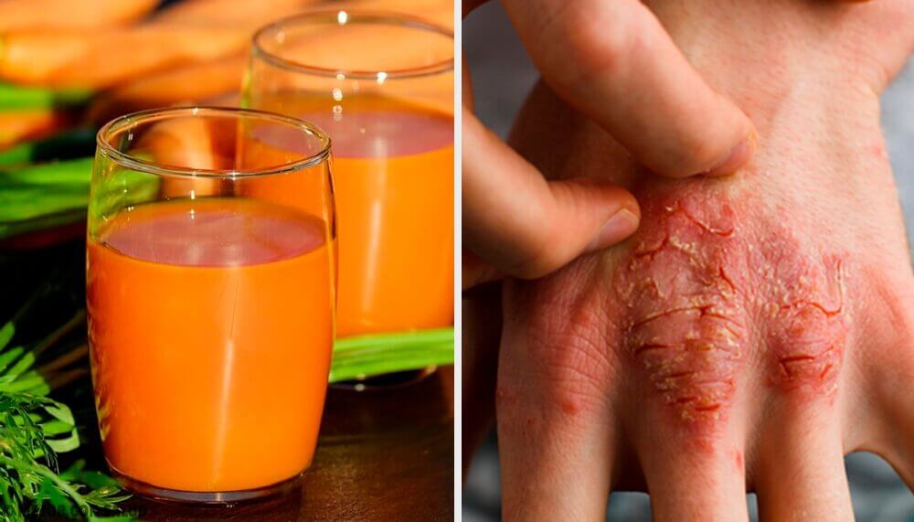 Prevent and Fight Against Psoriasis with these 7 Natural Remedies