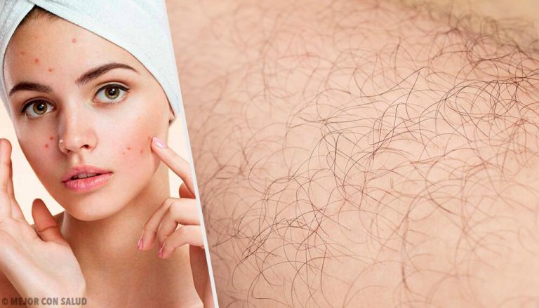 Causes of Hirsutism and Natural Remedies to Treat It