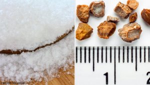 7 Home Remedies to Get Rid of Kidney Stones