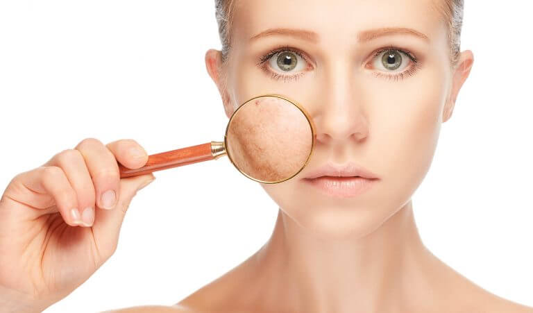 signs on your face: hyperpigmentation.