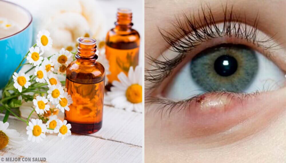 5 Easy Tricks for Treating Styes