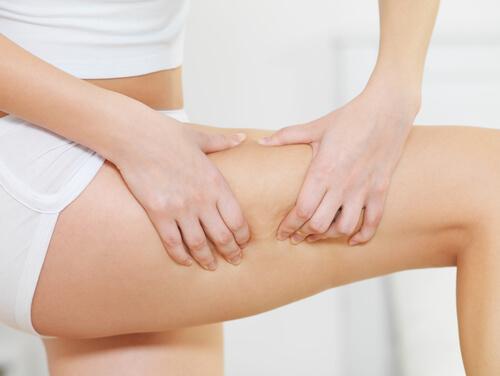 Cellulitis is not the same as cellulite.