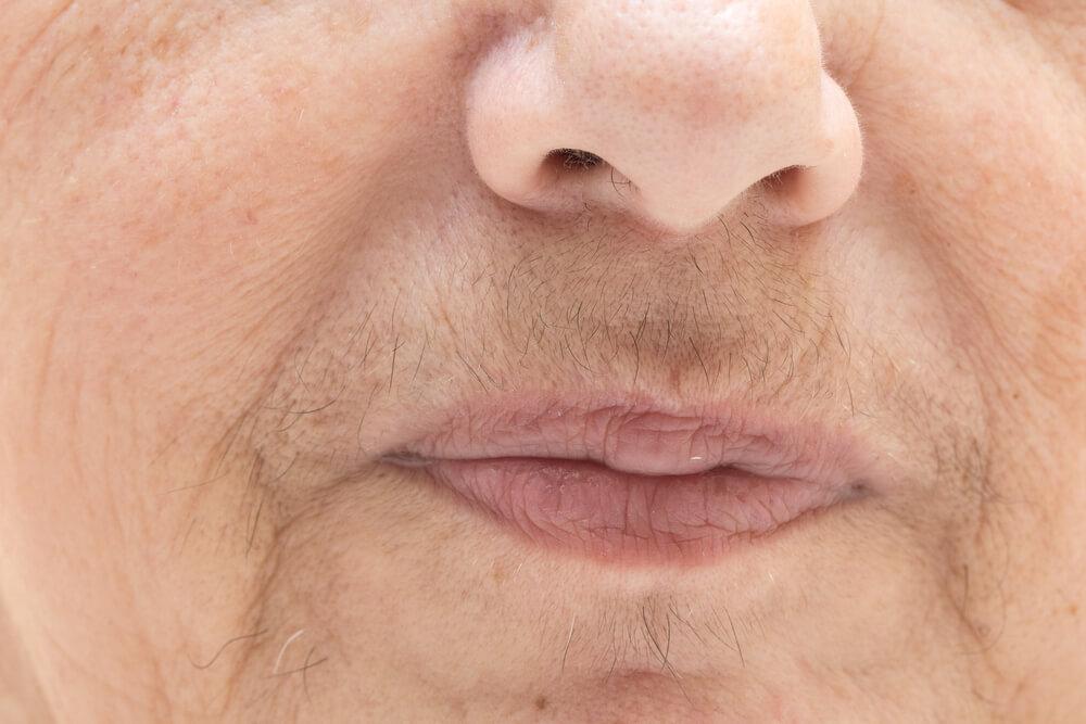 A woman with hirsutism on her lip.