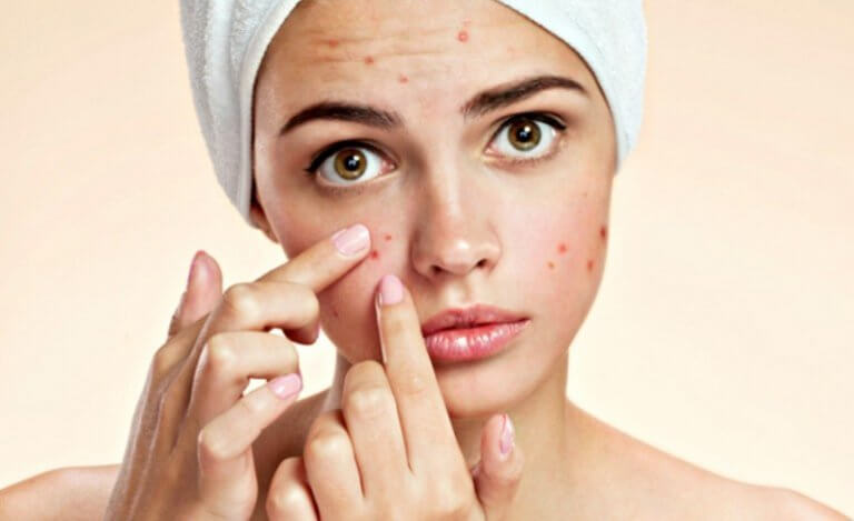 Vlekken of acne op het voorhoofd