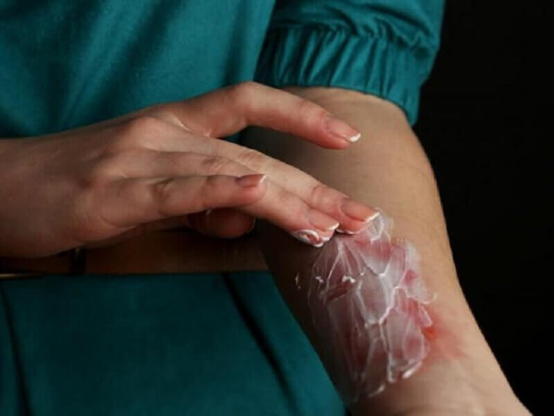 Yogurt Soothes burns