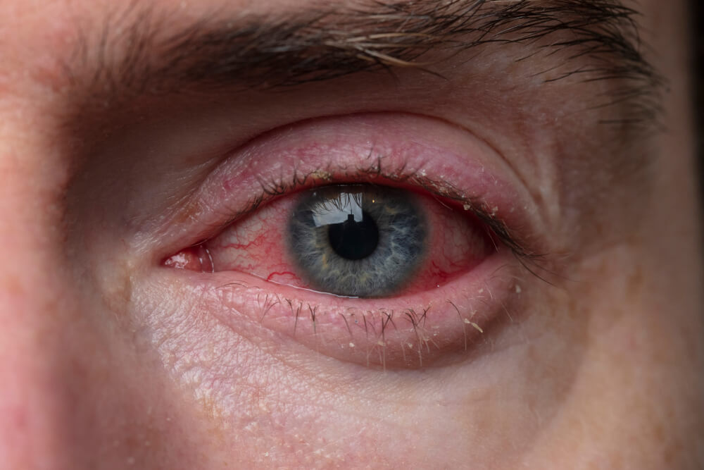 7 to Fight Pink Eye Naturally Step To Health