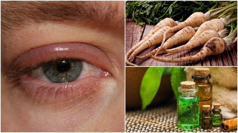 5 Home Remedies To Relieve Swollen Eyelids