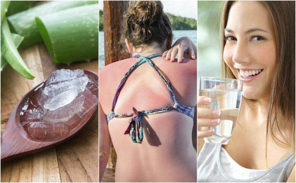 9 Ways to Treat Sunburns