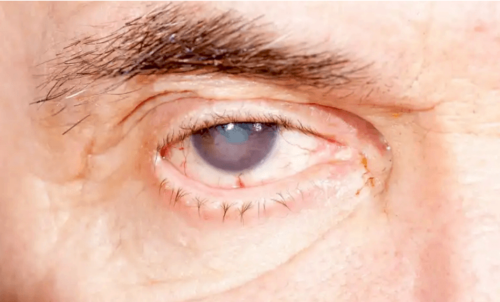 A man with poor vision.