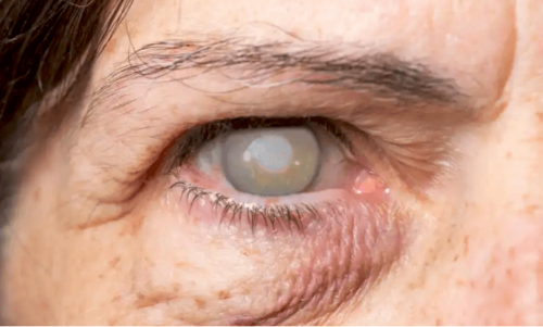 9 Symptoms of Cataracts and Natural Treatments
