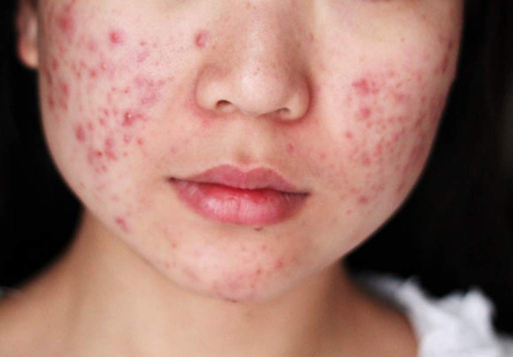 A girl with serious acne.