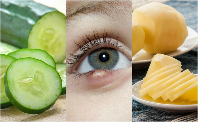 5 Natural Solutions for Curing Styes
