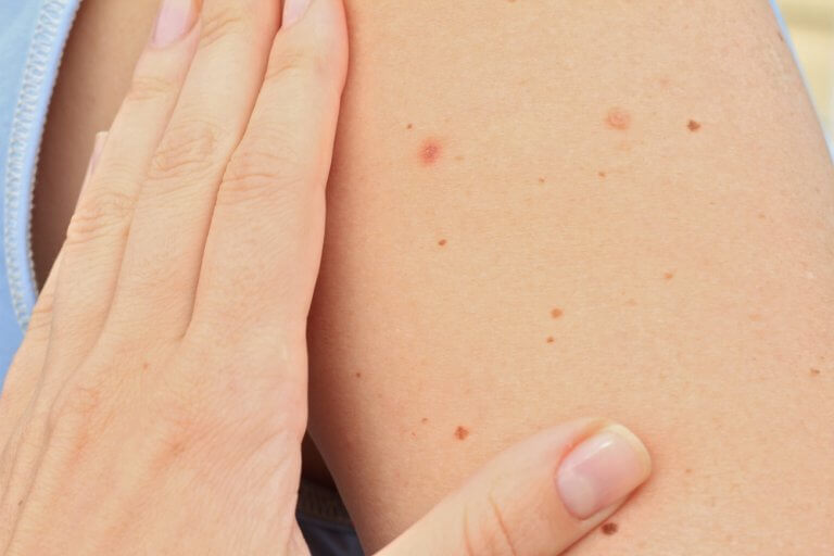 abnormal mole