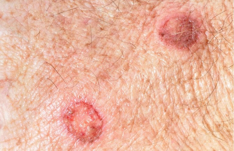 Moles and melanoma