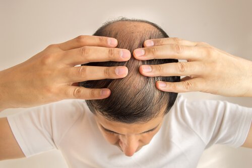 Hair loss myth: a bald man.