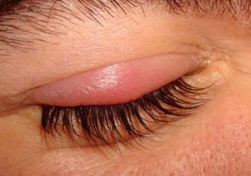 A person with a chalazion.