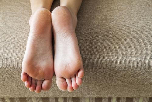 dry heels