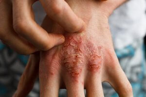 Treating Psoriasis With Sarsaparilla