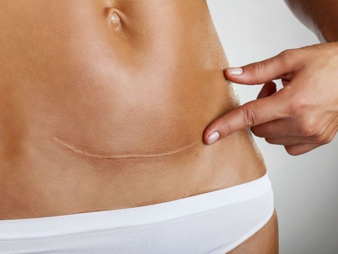 A belly scar.