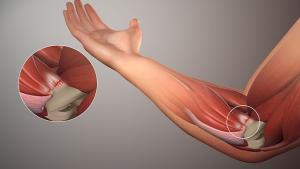 Natural Solutions for Tendonitis