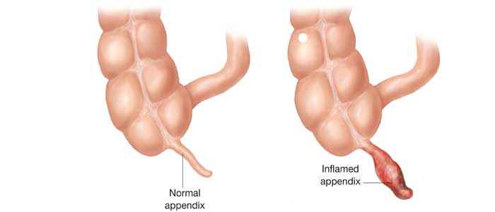 Symptome der Appendizitis "width =" 700 "height =" 300 "/></figure><p>Ihr Appendix kann aus mehreren Gründen verstopft sein:</p><ul><li>Die Anwesenheit von gehärteten, trockenen Fäkalien, bekannt als Fecalite;</li><li>Entzündung der Lymphknoten im Darm;</li><li>Die Anwesenheit von Parasiten.</li></ul><p>Wenn dein Blinddarm verstopft ist, entzündet er sich und das erste Symptom erscheint: Schmerz. Wenn dies eintritt, <strong>beginnen sich Bakterien sehr schnell zu vermehren</strong>. Der Blinddarm infiziert sich und kann reißen, wenn er nicht schnell entfernt wird, was die Gesundheit und das Leben eines Kindes ernsthaft gefährdet.</p><h2>Die Hauptsymptome der Blinddarmentzündung bei Kindern</h2><p>So wie der Appendix von Person zu Person in Größe und Lage variieren kann, <strong>treten bei Kindern variable Appendizitis-Symptome auf</strong>. Diese Symptome sind ziemlich häufig. So könnten sie auch von anderen Krankheiten herrühren, von einfachen <a href=